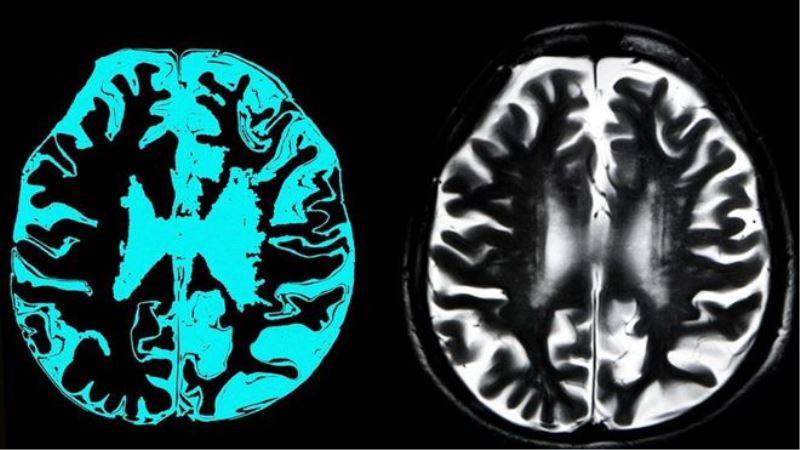 Alzheimer ilacı aducanumab AB´de kullanım için onaylanmadı